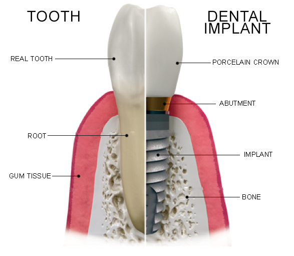illustrated comparison between a dental implant and a tooth