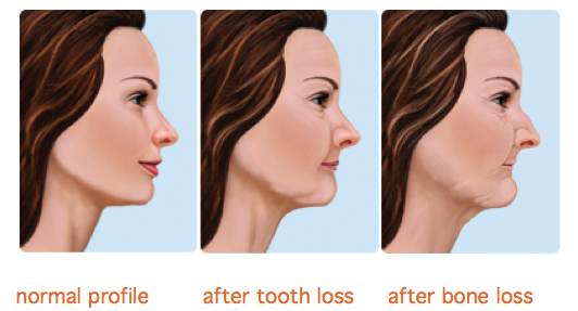 Illustration of a face in profile experiencing bone loss