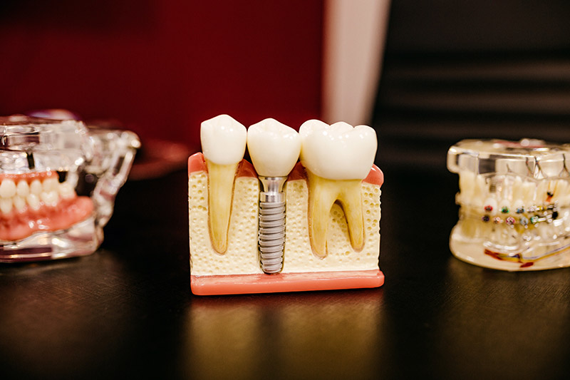 Dental implant typodont